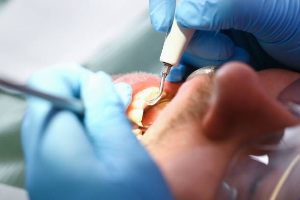 Best Emergency Root Canal Treatment in Burley, WA