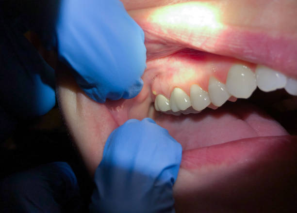 Best After-Hours Dental Trauma Care in Burley, WA