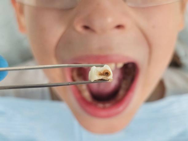 Best Urgent Care for Lost Fillings or Crowns in Burley, WA